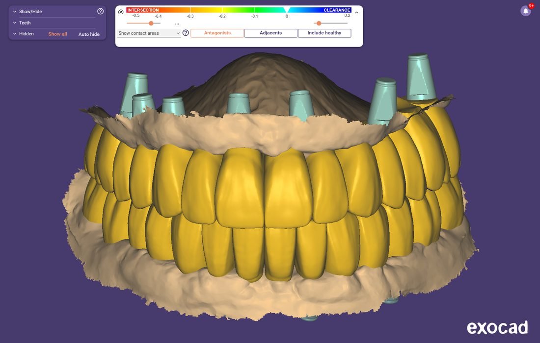 All-on-X digital prosthetic design with scan bodies and full-arch implant workflow