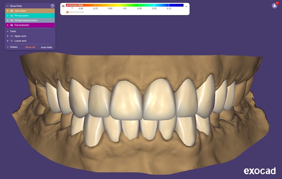 Full-arch esthetic wax-up and prosthetic setup for digital dentistry training