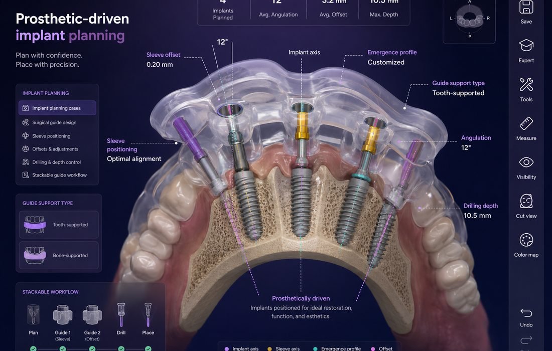Prosthetic-driven implant planning and surgical guide design with sleeve positioning, angulation, offset, and drilling depth