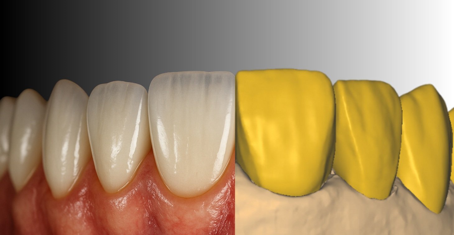 Before and after Redentive dental CAD design case