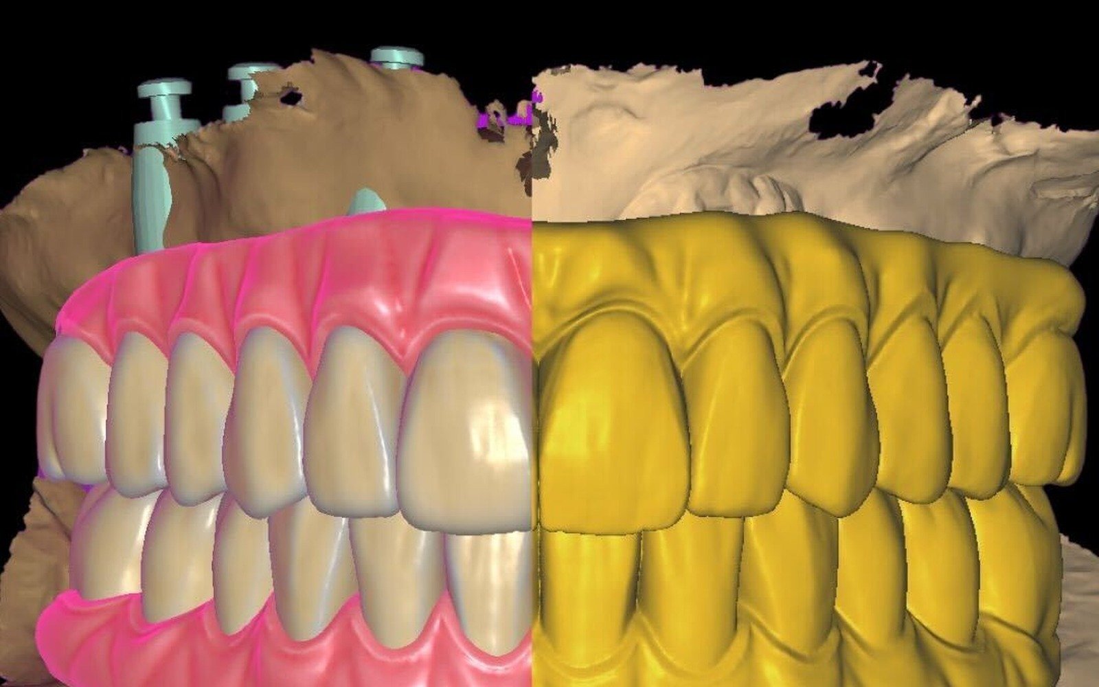 All-on-X design comparison