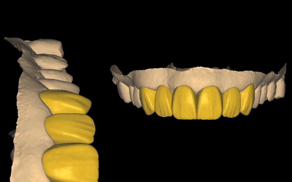 Anterior crown and bridge design