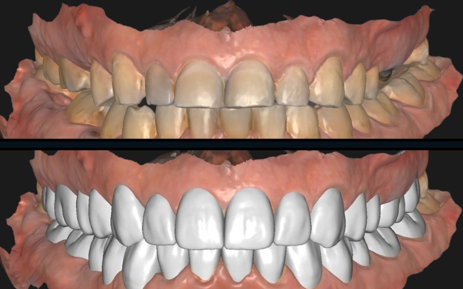 Before/after veneer planning