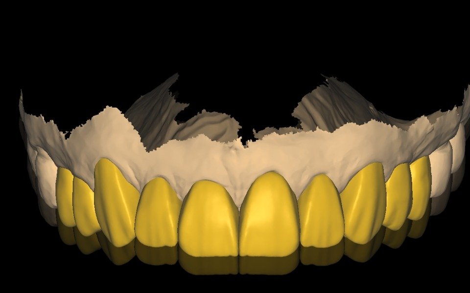 Full-arch wax-up planning