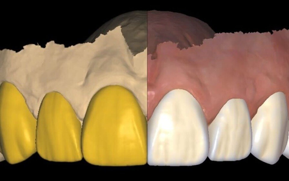 Non-prep veneer planning