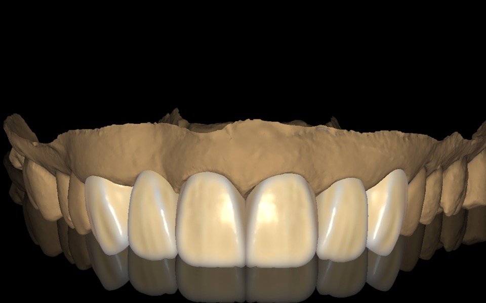 Anterior veneer design